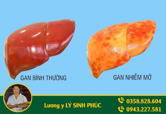 gan nhiễm mỡ