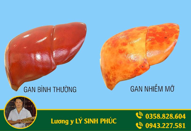gan nhiễm mỡ